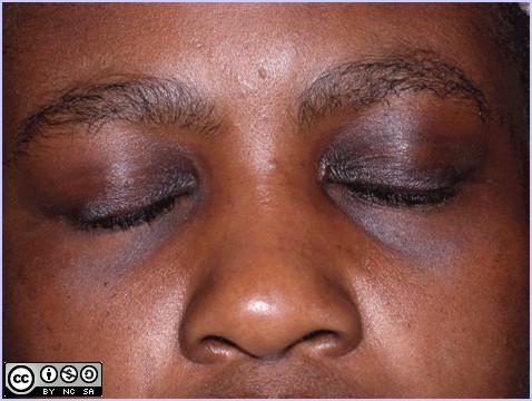 Post-Inflamatory Hyperpigmentation